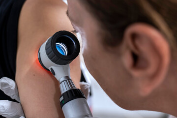 dermatologist examines birthmarks on the patient's skin with a dermatoscope. Dermatology, skin mole examining. looking for signs of melonoma or skin cancer. - obrazy, fototapety, plakaty