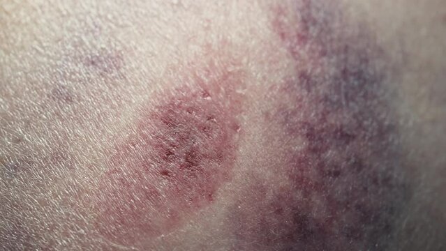 Big bruise hematoma after hit on human body skin. Congestion, macro. Health injury, pain, trauma concept. Domestic violence, home abuse