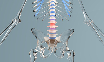 Stenosis of the lumbar spine in glass skeleton