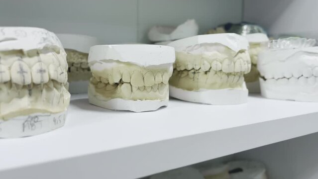 Various dental casts of jaw teeth, close up. Plaster teeth impression for orthodontic treatment of crooked teeth. Orthodontist dentist office. Artificial tooth crown. Dentistry care. Denture equipment