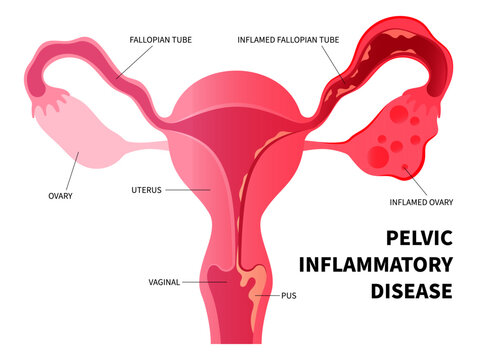 pelvic inflammatory disease and bacteria infection with ovary vagina painful