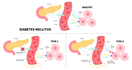 Glucagon hormone of Diabetes mellitus type 1 and 2 with insulin injection diagram of chronic metabolism disease anatomy - obrazy, fototapety, plakaty