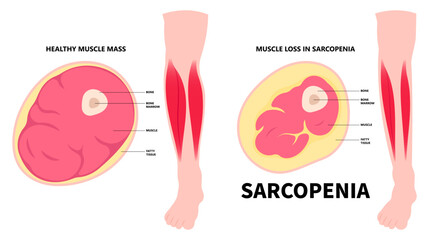 Leg muscle loss the Sarcopenia disorder that cause arm in older adults with body nerve pain injury of limb by low nutrition after aging - obrazy, fototapety, plakaty