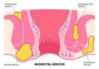 The hemorrhoids or colorectal fissure cancer with bleeding and infection after surgery - obrazy, fototapety, plakaty