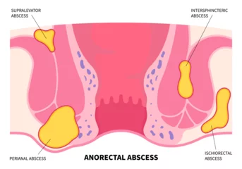 Deurstickers The hemorrhoids or colorectal fissure cancer with bleeding and infection after surgery © Pepermpron