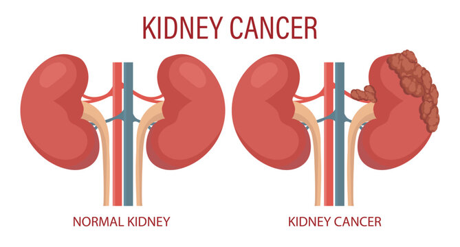 Kidney cancer. Human kidney disease. Medical infographic banner, illustration, vector
