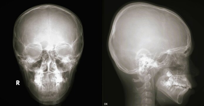 skull head bone x ray 