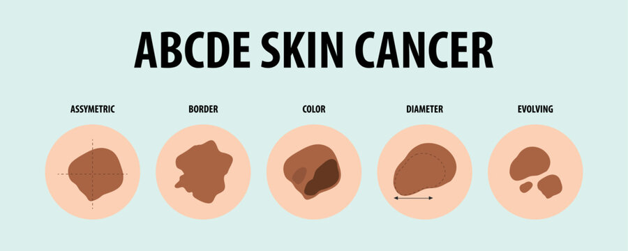 Illustrated Guide to Five Types of Skin Cancer