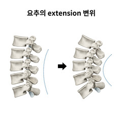 척추 요추 신전변위