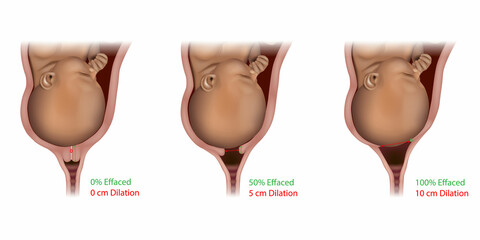 Cervical Effacement and Dilation During Delivery. Labor or delivery. Cervix changes from not effaced and dilated to fully effaced and totally - obrazy, fototapety, plakaty