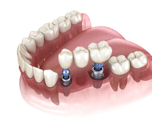 Dental bridge supported by implants. 3D illustration of human teeth and dentures concept