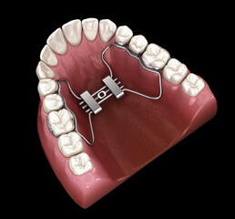 Rapid Palatal Expansion. Medically accurate tooth 3D illustration - 677620595