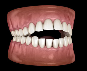 Openbite dental occlusion (Malocclusion of teeth). Medically accurate tooth 3D illustration