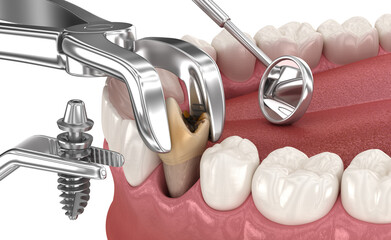 Extraction and Implantation, complex immediate surgery. Medically accurate 3D illustration of dental treatment - 677620726