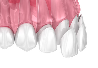 Dental veneer placement over frontal teeth. 3D illustration