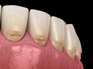 Teeth abfraction. Dental 3D illustration