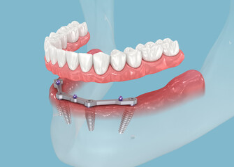 Mandibular prosthesis with gum All on 4 system supported by implants. Medically accurate 3D illustration - 677621100
