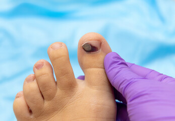 hematoma wound on runner's toe nail. consequences of wearing uncomfortable shoes or hit.feet on...