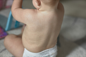 A baby's rash, a rash on the skin, a harmless non-dangerous viral infection caused by two strains...