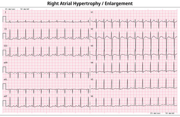 ECG Right Atrial Enlargement (RAE) - Right Atrial Hypertrophy (RAH) - 12 Lead ECG Common Case - 6 Sec/lead - Electrocardiogram Medical Vector Illustration - obrazy, fototapety, plakaty