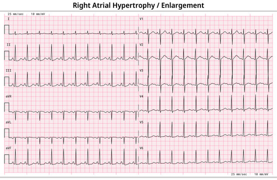 ECG Right Atrial Enlargement (RAE) - Right Atrial Hypertrophy (RAH) - 12 Lead ECG Common Case - 6 Sec/lead - Electrocardiogram Medical Vector Illustration