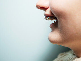 Young teenager girl with metal teeth bracket and extreme tooth angle. Health care and beauty...