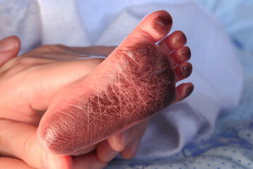 The soles of newborn babies' feet