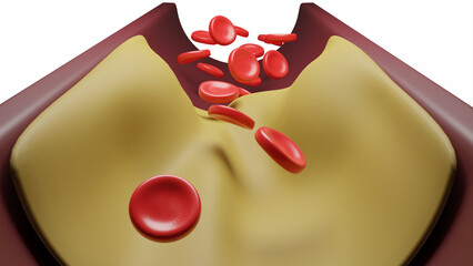 Hyperlipidemia. Blocked artery concept and human blood vessel as a disease with cholesterol fat buildup clogging.