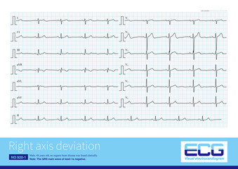 Right axis deviation can be seen both in right ventricular hypertrophy and in some healthy people, who have no ECG abnormalities except for right axis deviation.