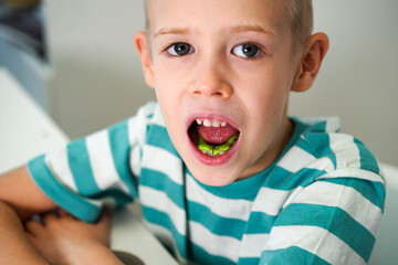 Boy wears dental plate on the lower jaw, jaw expander - obrazy, fototapety, plakaty