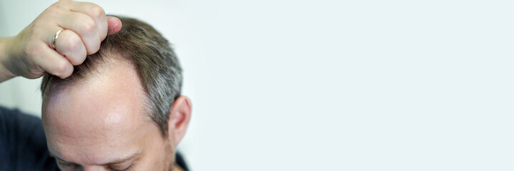 Baldness on the head of a middle-aged man. Hair loss.