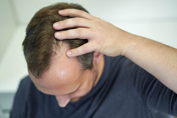 Baldness on the head of a middle-aged man. Hair loss.