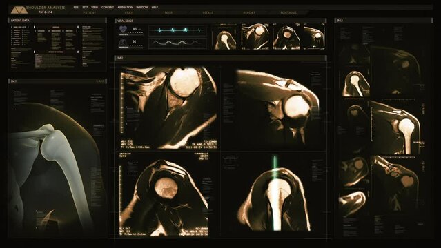 
Medical Profile of Patient Showing Shoulder MRI Scan. Vital Signs and Several Healthcare Information. Futuristic Technological Interface Analyzing Human Anatomy.