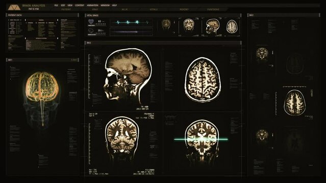 Futuristic Interface Patient Information Showing Several Views of Brain MRI, Vital Signs and 3D Model of this Organ. Diagnosis Medical Data.