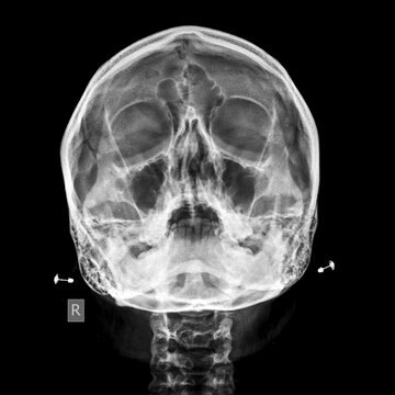 x ray of human skull sinus view (skull waters view)