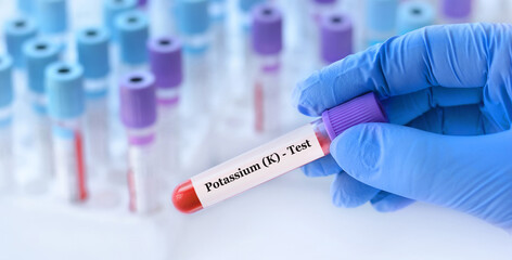 Doctor holding a test blood sample tube with potassium test on the background of medical test tubes with analyzes