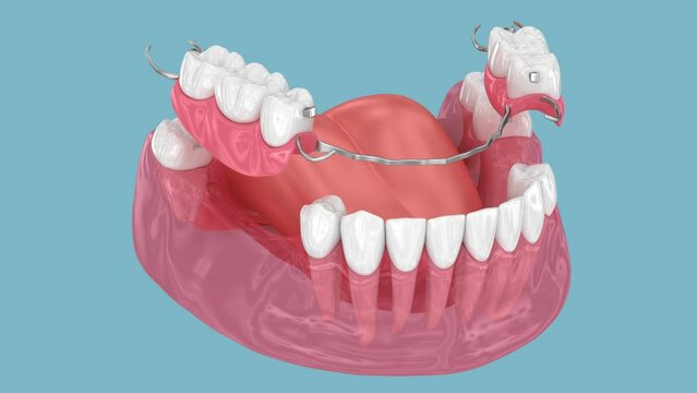 Removable partial denture, mandibular prosthesis. Medically accurate 3D animation of prosthodontics concept