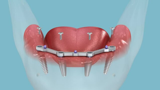 Mandibular prosthesis with gum All on 4 system supported by implants.  Medically accurate 3D animation