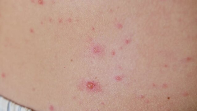 The classic symptom of chickenpox is a rash that turns into itchy, fluid-filled blisters.