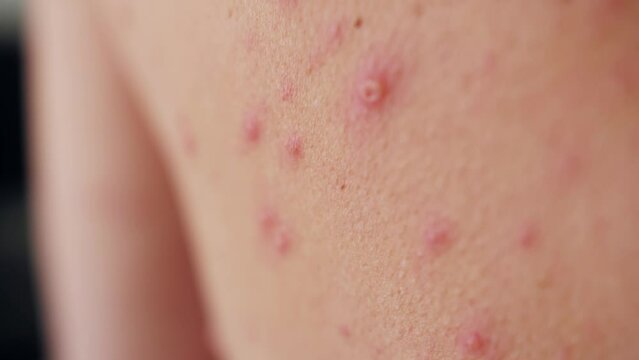 Close-up of chicken pox on the back of an adult person. The classic symptom of chickenpox is a rash that turns into itchy, fluid-filled blisters.