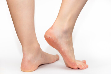 Close up of female legs with peeling skin of soles on heels. White background. Skin care and pedicure - obrazy, fototapety, plakaty