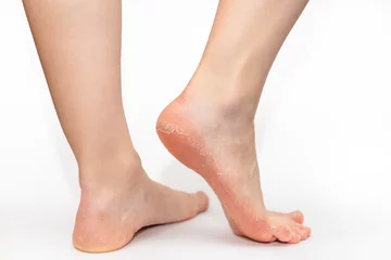 Crédence de cuisine en verre imprimé Pédicure Close up of female legs with peeling skin of soles on heels. White background. Skin care and pedicure