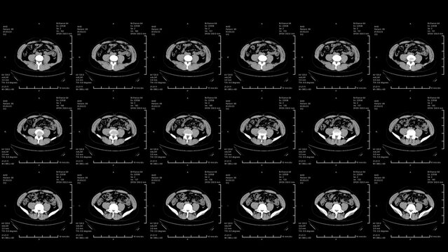 CT scan. 3 to 6 MRI x ray Scan.Medical HUD Analyzing abdominal appendicitis diagnosis. Technological Interface. Healthcare. 2D 