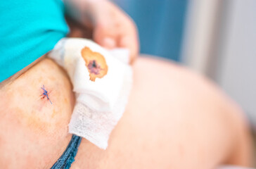 Hip and leg with wound and stitches with one hand removing dirty gauze