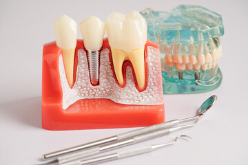 Dental implant, artificial tooth roots into jaw, root canal of dental treatment, gum disease, teeth...