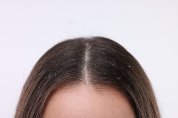Woman with dandruff problem on white background, closeup