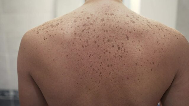 Pigmented skin on a man's back
