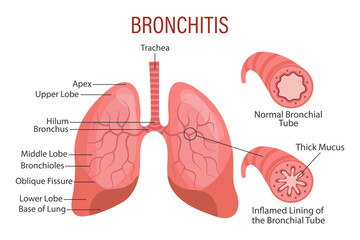 Bronchitis, a lung disease. Healthcare. Medical infographic banner, illustration, vector - obrazy, fototapety, plakaty