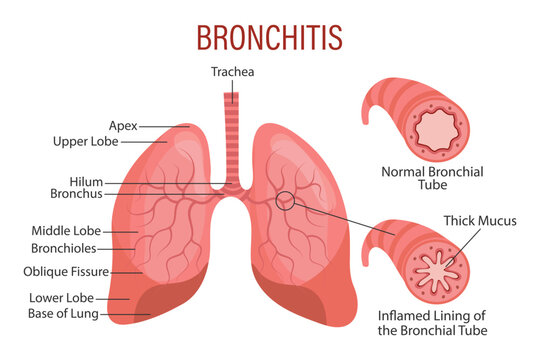 Bronchitis, a lung disease. Healthcare. Medical infographic banner, illustration, vector