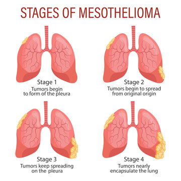Stages of mesothelioma, lung disease. Healthcare. Medical infographic banner, illustration, vector